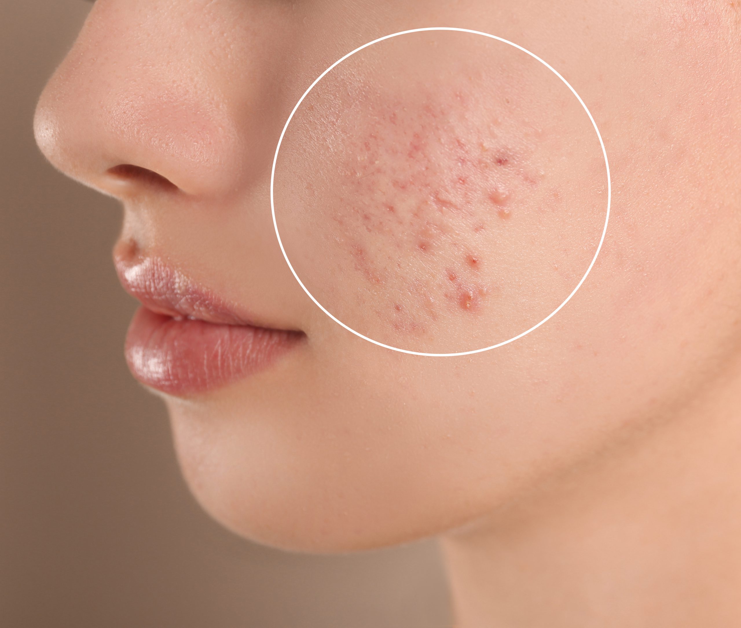 Teenage girl with acne problem on beige background, closeup